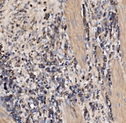 IHC staining of FFPE human stomach cancer tissue with Gephyrin antibody. HIER: boil tissue sections in pH8 EDTA for 20 min and allow to cool before testing.
