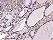 IHC staining of FFPE human papillary thyroid carcinoma tissue with Gephyrin antibody. HIER: boil tissue sections in pH8 EDTA for 20 min and allow to cool before testing.