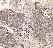IHC staining of FFPE human liver cancer tissue with Gephyrin antibody. HIER: boil tissue sections in pH8 EDTA for 20 min and allow to cool before testing.