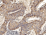 IHC staining of FFPE human liver cancer tissue with HIP1R antibody. HIER: boil tissue sections in pH8 EDTA for 20 min and allow to cool before testing.
