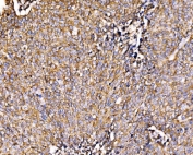 IHC staining of FFPE human lung cancer tissue with HIP1R antibody. HIER: boil tissue sections in pH8 EDTA for 20 min and allow to cool before testing.