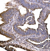 IHC staining of FFPE human rectal cancer tissue with HIP1R antibody. HIER: boil tissue sections in pH8 EDTA for 20 min and allow to cool before testing.