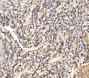 IHC staining of FFPE human renal clear cell carcinoma tissue with HIP1R antibody. HIER: boil tissue sections in pH8 EDTA for 20 min and allow to cool before testing.