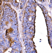 IHC staining of FFPE human rectal cancer tissue with 5HT1B antibody. HIER: boil tissue sections in pH8 EDTA for 20 min and allow to cool before testing.