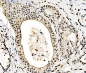 IHC staining of FFPE human gall bladder adenosquamous carcinoma tissue with JUNB antibody. HIER: boil tissue sections in pH8 EDTA for 20 min and allow to cool before testing.