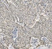 IHC staining of FFPE human lung cancer tissue with JUNB antibody. HIER: boil tissue sections in pH8 EDTA for 20 min and allow to cool before testing.