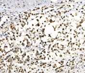 IHC staining of FFPE human pancreatic cancer tissue with JUNB antibody. HIER: boil tissue sections in pH8 EDTA for 20 min and allow to cool before testing.