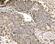 IHC staining of FFPE human liver cancer tissue with LACTB antibody. HIER: boil tissue sections in pH8 EDTA for 20 min and allow to cool before testing.