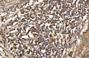 IHC staining of FFPE human lung cancer tissue with ASK1 antibody. HIER: boil tissue sections in pH8 EDTA for 20 min and allow to cool before testing.