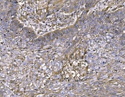 IHC staining of FFPE human lung cancer tissue with FAM129B antibody. HIER: boil tissue sections in pH8 EDTA for 20 min and allow to cool before testing.