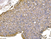 IHC staining of FFPE human liver cancer tissue with P2X7 antibody. HIER: boil tissue sections in pH8 EDTA for 20 min and allow to cool before testing.