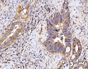IHC staining of FFPE human gall bladder adenosquamous carcinoma tissue with P2X7 antibody. HIER: boil tissue sections in pH8 EDTA for 20 min and allow to cool before testing.