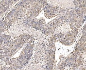 IHC staining of FFPE human liver cancer tissue with PAK1 antibody. HIER: boil tissue sections in pH8 EDTA for 20 min and allow to cool before testing.