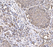 IHC staining of FFPE human lung cancer tissue with PAK1 antibody. HIER: boil tissue sections in pH8 EDTA for 20 min and allow to cool before testing.