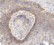 IHC staining of FFPE human laryngeal squamous cell carcinoma tissue with RPL8 antibody. HIER: boil tissue sections in pH8 EDTA for 20 min and allow to cool before testing.