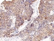 IHC staining of FFPE human liver cancer tissue with RPL8 antibody. HIER: boil tissue sections in pH8 EDTA for 20 min and allow to cool before testing.