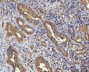 IHC staining of FFPE human gall bladder adenosquamous carcinoma tissue with RPL10 antibody. HIER: boil tissue sections in pH8 EDTA for 20 min and allow to cool before testing.