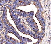 IHC staining of FFPE human rectal cancer tissue with SCRN1 antibody. HIER: boil tissue sections in pH8 EDTA for 20 min and allow to cool before testing.