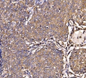 IHC staining of FFPE human lung cancer tissue with SCRN1 antibody. HIER: boil tissue sections in pH8 EDTA for 20 min and allow to cool before testing.