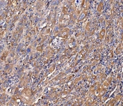 IHC staining of FFPE human gall bladder adenosquamous carcinoma tissue with SCRN1 antibody. HIER: boil tissue sections in pH8 EDTA for 20 min and allow to cool before testing.