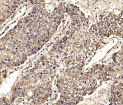 IHC staining of FFPE human liver cancer tissue with SCRN1 antibody. HIER: boil tissue sections in pH8 EDTA for 20 min and allow to cool before testing.