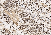 IHC staining of FFPE human gastric cancer tissue with SPHK1 antibody. HIER: boil tissue sections in pH8 EDTA for 20 min and allow to cool before testing.