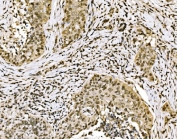 IHC staining of FFPE human lung cancer tissue with SPHK1 antibody. HIER: boil tissue sections in pH8 EDTA for 20 min and allow to cool before testing.