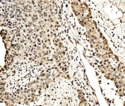 IHC staining of FFPE human liver cancer tissue with SPHK1 antibody. HIER: boil tissue sections in pH8 EDTA for 20 min and allow to cool before testing.