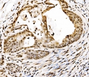 IHC staining of FFPE human gall bladder adenosquamous carcinoma tissue with SPHK1 antibody. HIER: boil tissue sections in pH8 EDTA for 20 min and allow to cool before testing.