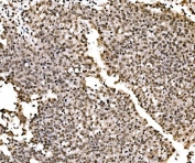IHC staining of FFPE human laryngeal squamous cell carcinoma tissue with SPHK1 antibody. HIER: boil tissue sections in pH8 EDTA for 20 min and allow to cool before testing.