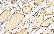 IHC staining of FFPE human papillary thyroid carcinoma tissue with SPHK1 antibody. HIER: boil tissue sections in pH8 EDTA for 20 min and allow to cool before testing.