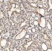 IHC staining of FFPE human Hashintoto's thyroditis tissue with SPHK1 antibody. HIER: boil tissue sections in pH8 EDTA for 20 min and allow to cool before testing.