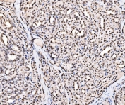 IHC staining of FFPE human thyroid papillary carcinoma tissue with SSB antibody. HIER: boil tissue sections in pH8 EDTA for 20 min and allow to cool before testing.