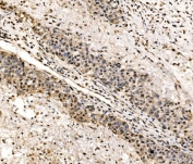 IHC staining of FFPE human liver cancer tissue with SSB antibody. HIER: boil tissue sections in pH8 EDTA for 20 min and allow to cool before testing.