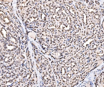 IHC staining of FFPE human thyroid papillary carcinoma tissue with SSB antibody. HIER: boil tissue sections in pH8 EDTA for 20 min and allow to cool before testing.