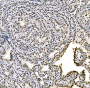 IHC staining of FFPE human Hashimoto's thyroiditis tissue with SSB antibody. HIER: boil tissue sections in pH8 EDTA for 20 min and allow to cool before testing.
