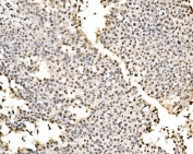 IHC staining of FFPE human laryngeal carcinoma tissue with SSB antibody. HIER: boil tissue sections in pH8 EDTA for 20 min and allow to cool before testing.