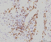 IHC staining of FFPE human gastric carcinoma tissue with RAB11A antibody. HIER: boil tissue sections in pH8 EDTA for 20 min and allow to cool before testing.