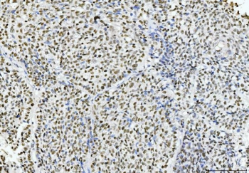 IHC staining of FFPE human lung cancer tissue with Cyclophilin E antibody. HIER: boil tissue sections in pH8 EDTA for 20 min and allow to cool before testing.