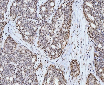 IHC staining of FFPE human gall bladder adenosquamous carcinoma tissue with Cyclophilin E antibody. HIER: boil tissue sections in pH8 EDTA for 20 min and allow to cool before testing.