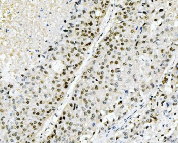 IHC staining of FFPE human liver cancer tissue with Cyclophilin E antibody. HIER: boil tissue sections in pH8 EDTA for 20 min and allow to cool before testing.