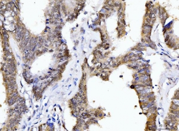 IHC staining of FFPE human colonic adenocarcinoma tissue with Cyclophilin E antibody. HIER: boil tissue sections in pH8 EDTA for 20 min and allow to cool before testing.