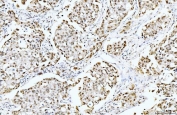 IHC staining of FFPE human breast cancer tissue with Cyclophilin E antibody. HIER: boil tissue sections in pH8 EDTA for 20 min and allow to cool before testing.