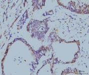 IHC staining of FFPE human colonic adenocarcinoma tissue with PPIE antibody. HIER: boil tissue sections in pH8 EDTA for 20 min and allow to cool before testing.