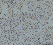 IHC staining of FFPE human renal clear cell carcinoma tissue with LSM8 antibody. HIER: boil tissue sections in pH8 EDTA for 20 min and allow to cool before testing.
