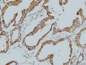 IHC staining of FFPE human colonic adenocarcinoma tissue with LSM8 antibody. HIER: boil tissue sections in pH8 EDTA for 20 min and allow to cool before testing.