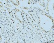 IHC staining of FFPE human liver cancer tissue with PSMC3 antibody. HIER: boil tissue sections in pH8 EDTA for 20 min and allow to cool before testing.