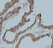 IHC staining of FFPE human colonic adenocarcinoma tissue with PSMC3 antibody. HIER: boil tissue sections in pH8 EDTA for 20 min and allow to cool before testing.