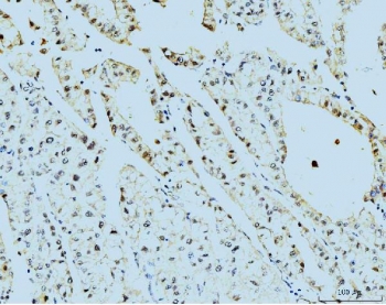 IHC staining of FFPE human liver cancer tissue with PSMC3 antibody. HIER: boil tissue sections in pH8 EDTA for 20 min and allow to cool before testing.