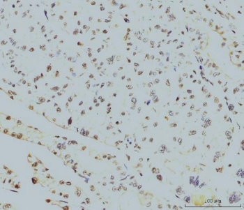 IHC staining of FFPE human liver cancer tissue with Replication Protein A2 antibody. HIER: boil tissue sections in pH8 EDTA for 20 min and allow to cool before testing.
